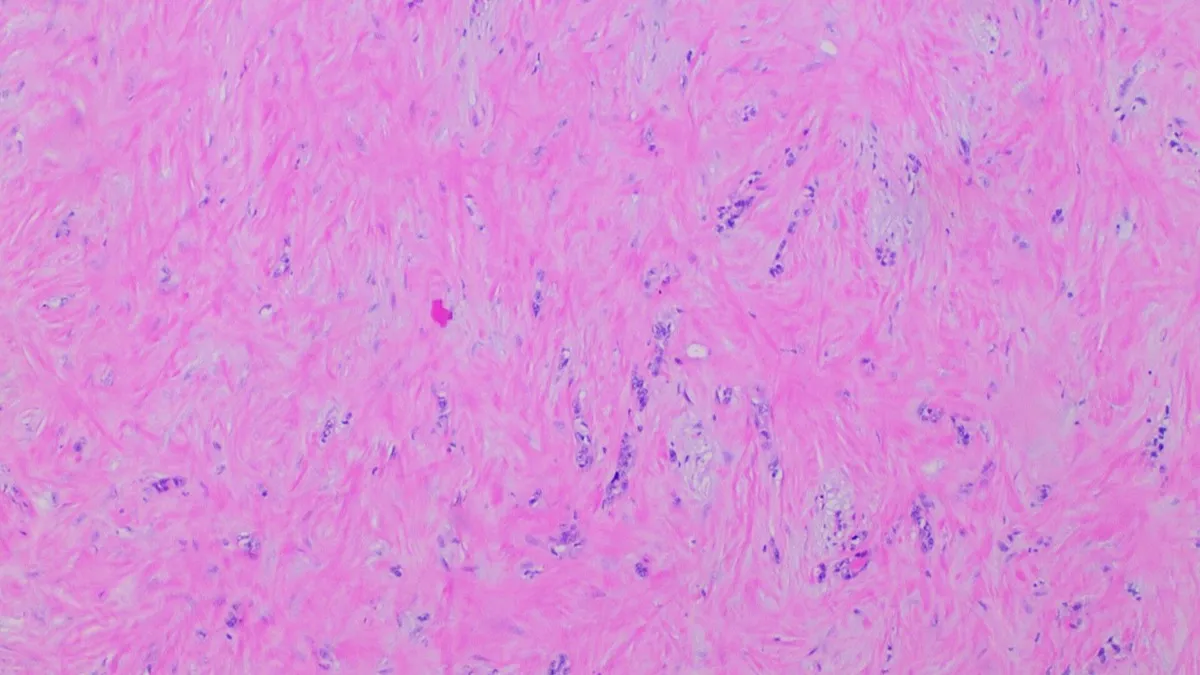 Corte histológico teñido de un adenocarcinoma de páncreas tras tratamiento, con tejido rosado y glándulas alteradas